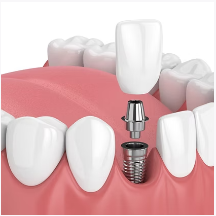 Implants