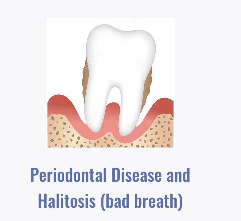 Periodontal Disease & Halitosis