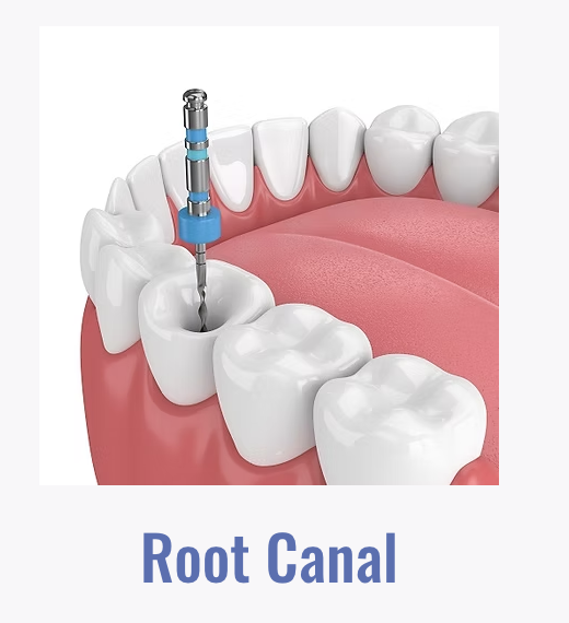 Root Canal