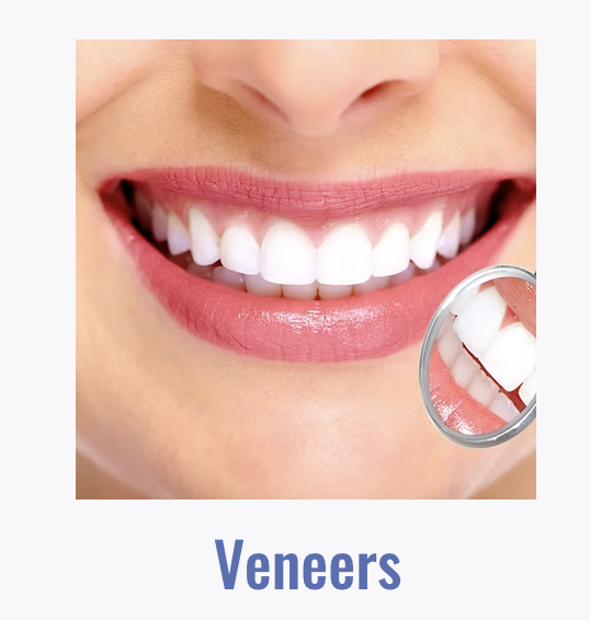 Veneers